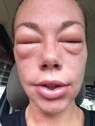 What is Anaphylaxis? « Health and Safety Training & Solutions - Demack ... Makeup Allergic Reaction